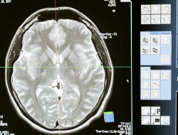 Kontrastsız Beyin BT Taraması Nedir? Nasıl Yapılır?